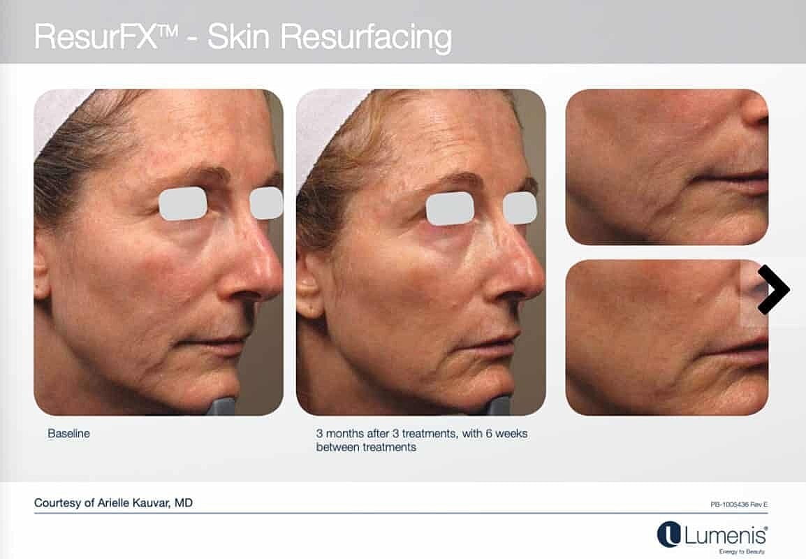 Are you looking for a facial rejuvenation treatment without downtime?