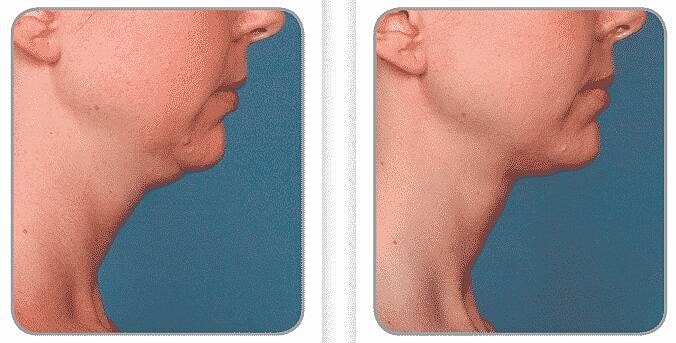 Kybella works well to get rid of that double chin!