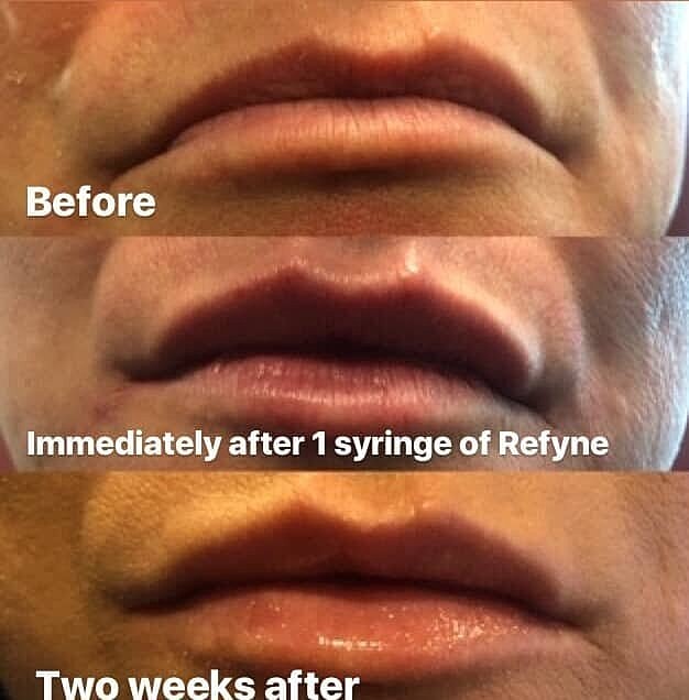 Lip Fillers: Naturally full lips