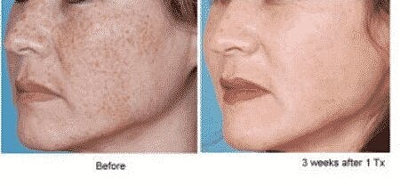 PhotoFacial – Beautiful Skin with the Power of Light