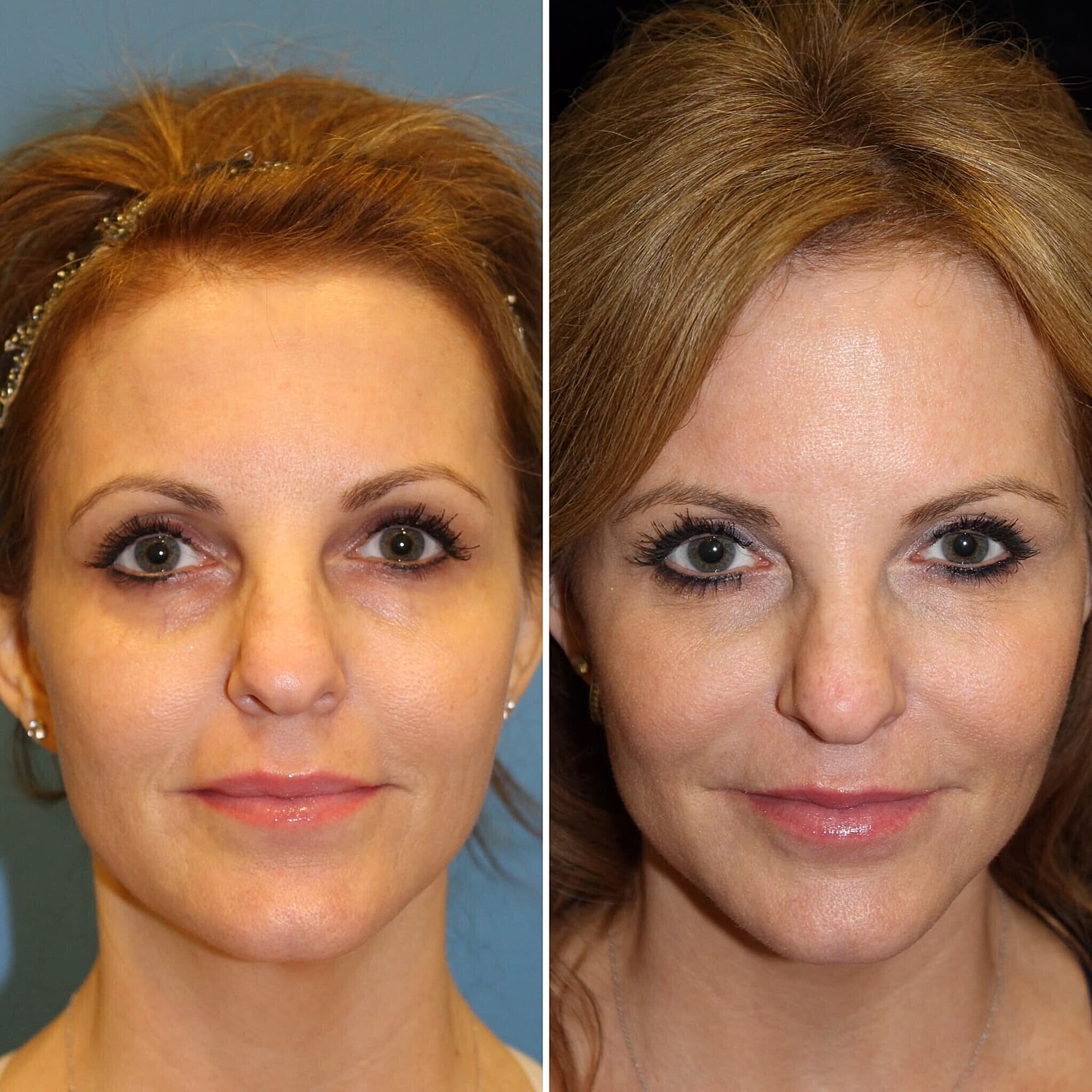 Volbella to Smooth Undereye Hollows