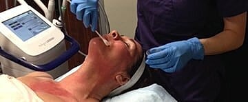 What is Radio Frequency Microneedling?