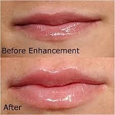 You’ve just had your lips enhanced, now what?
