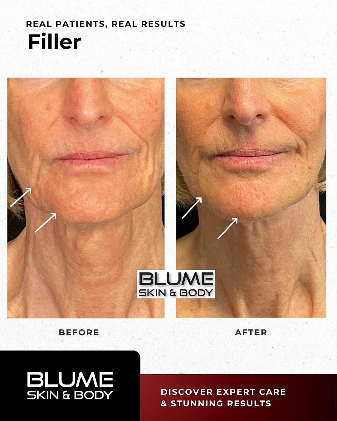 Before and after filler treatment results.