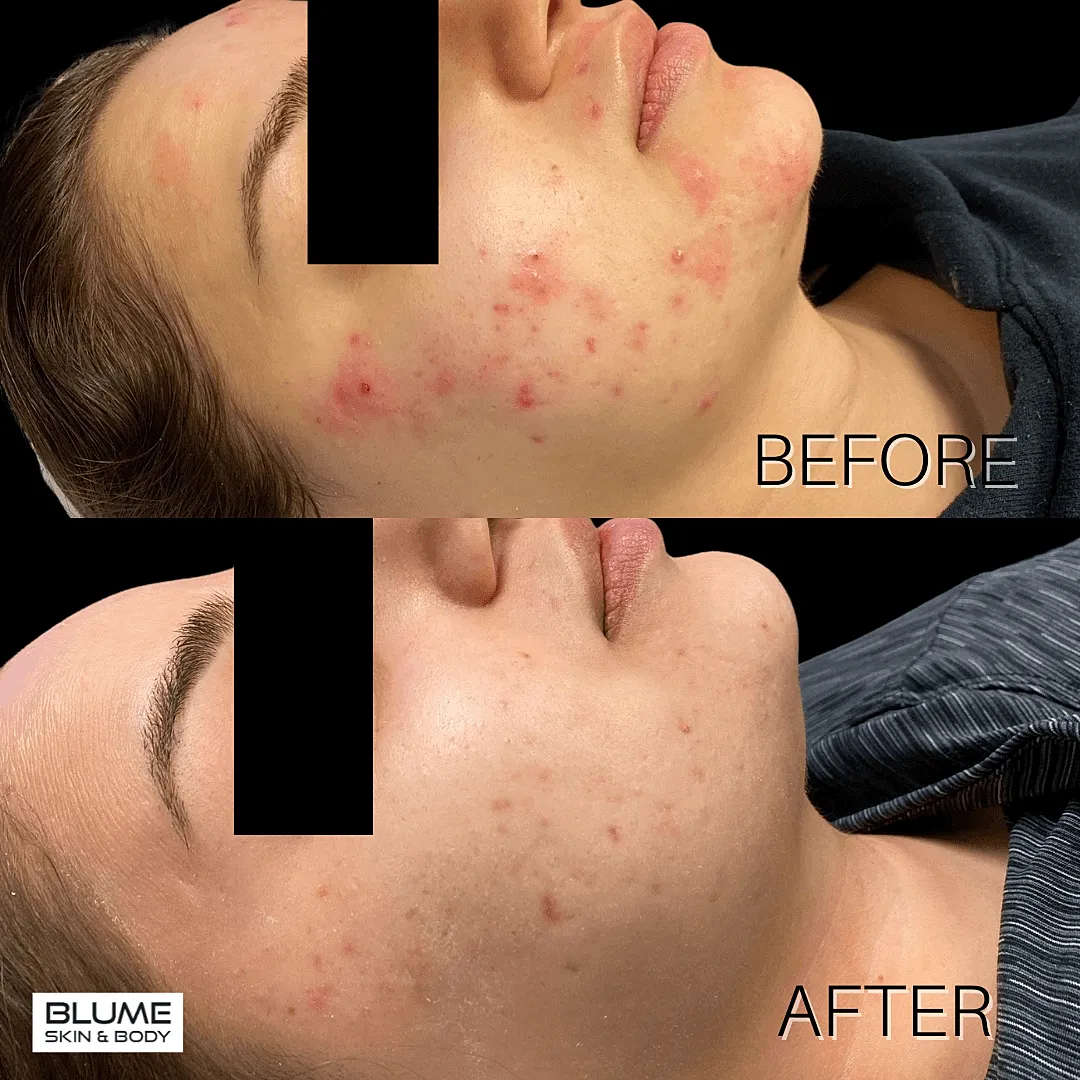 Before and after skin treatment transformation.