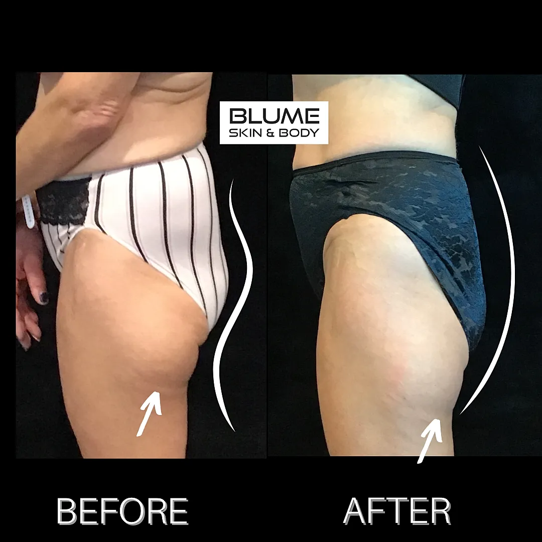Before and after thigh treatment comparison.