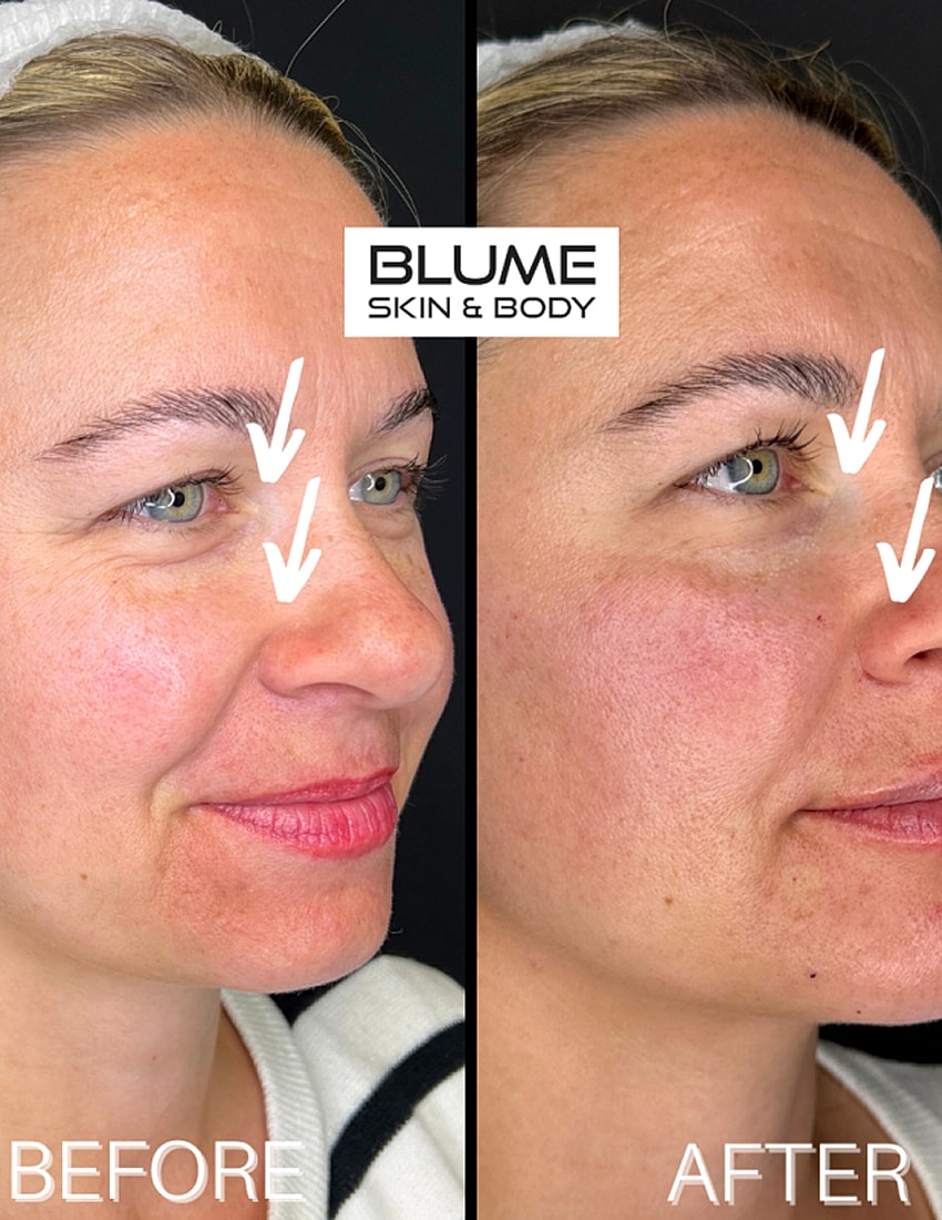 Facial treatment before and after results comparison.