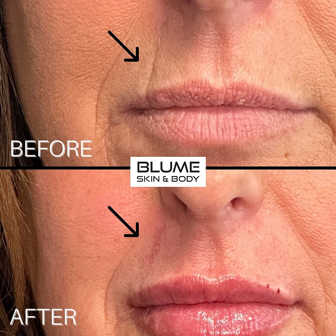 Skin improvement before and after treatment.