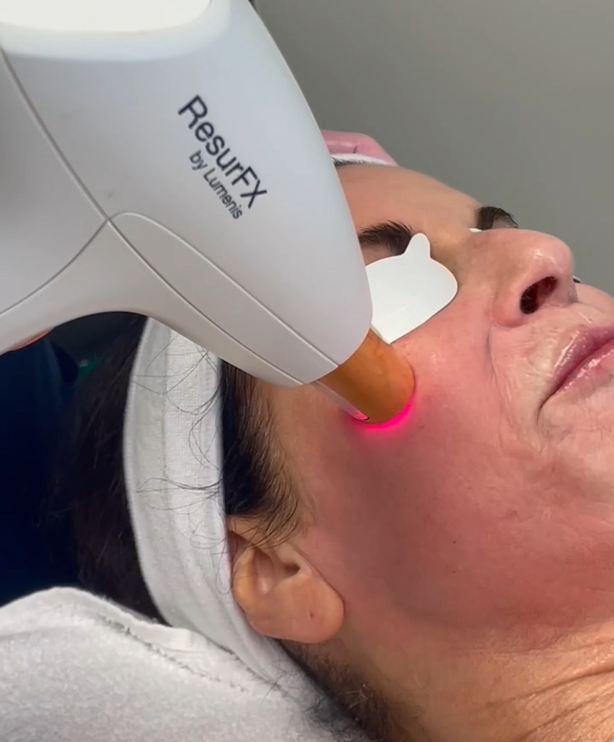 Laser treatment on a woman's face.