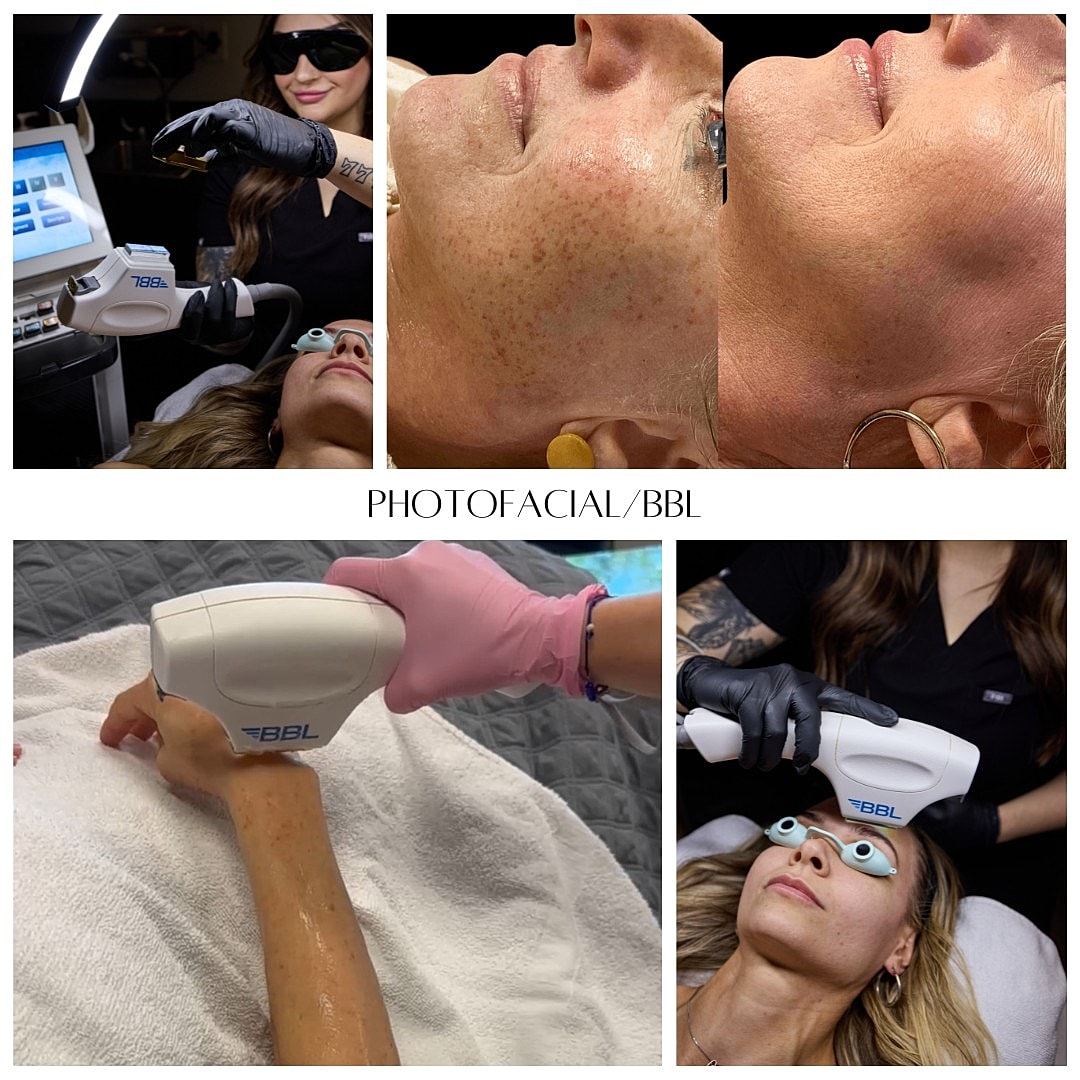BBL photo facial treatment process and results.