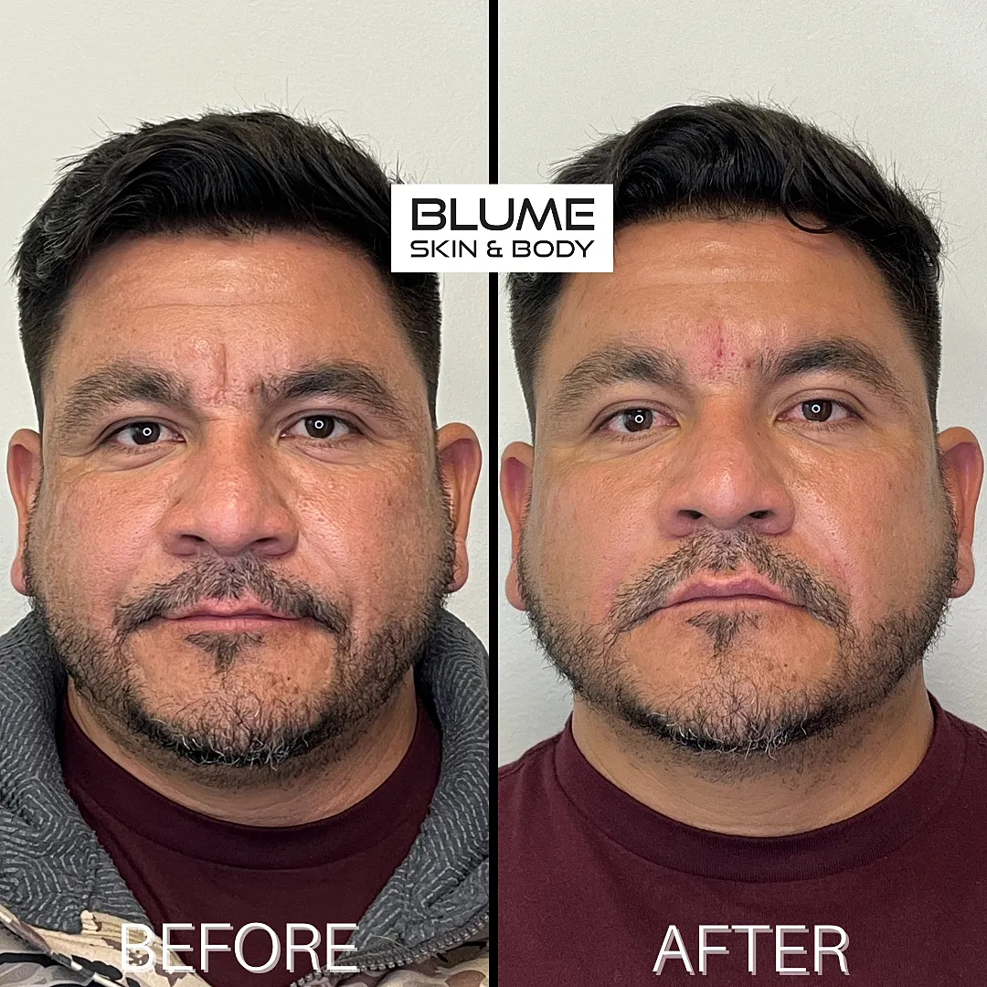 Image comparison of skincare treatment results.