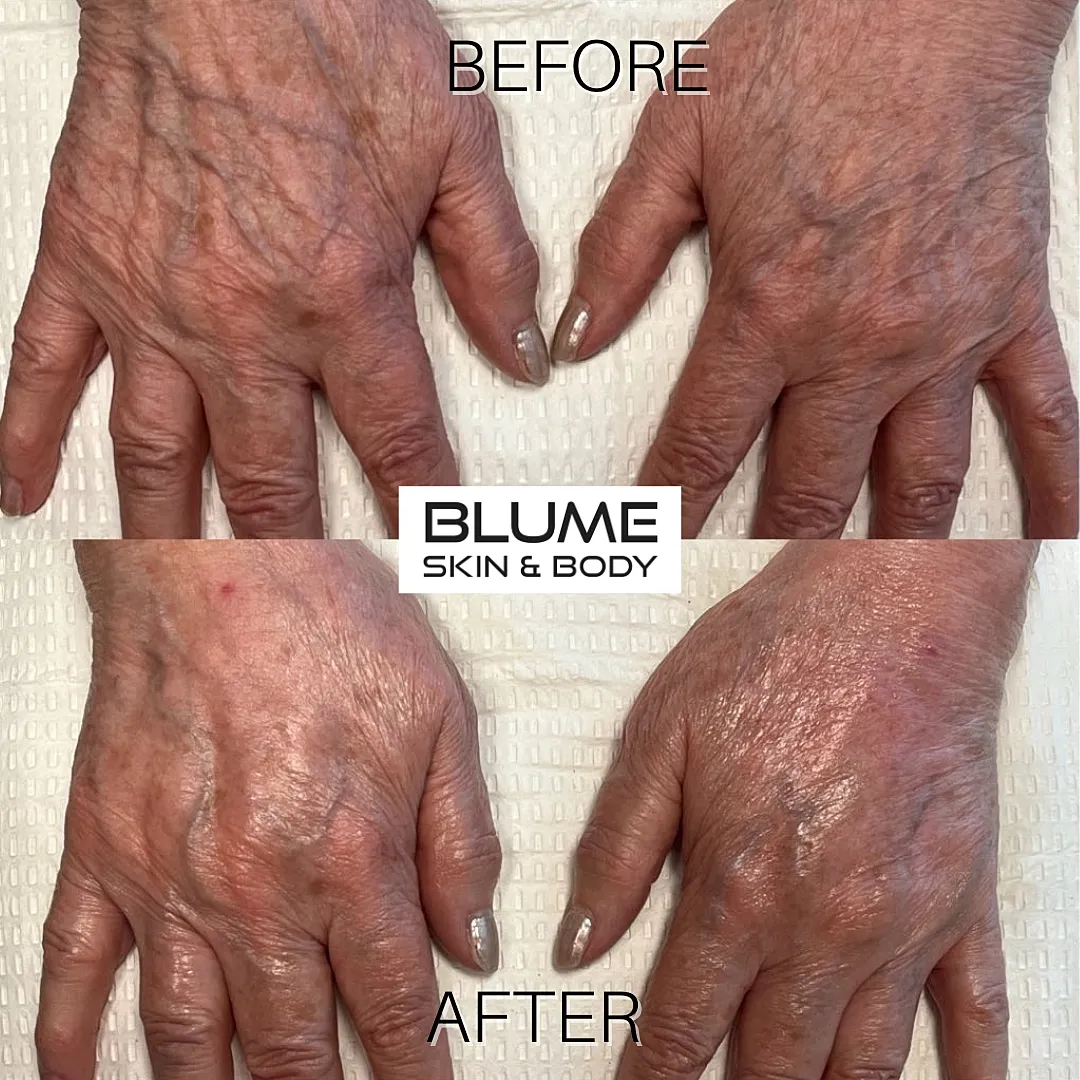 Before and after hand treatment results.