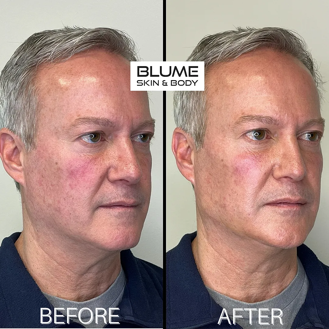 Man's facial transformation before and after treatment.