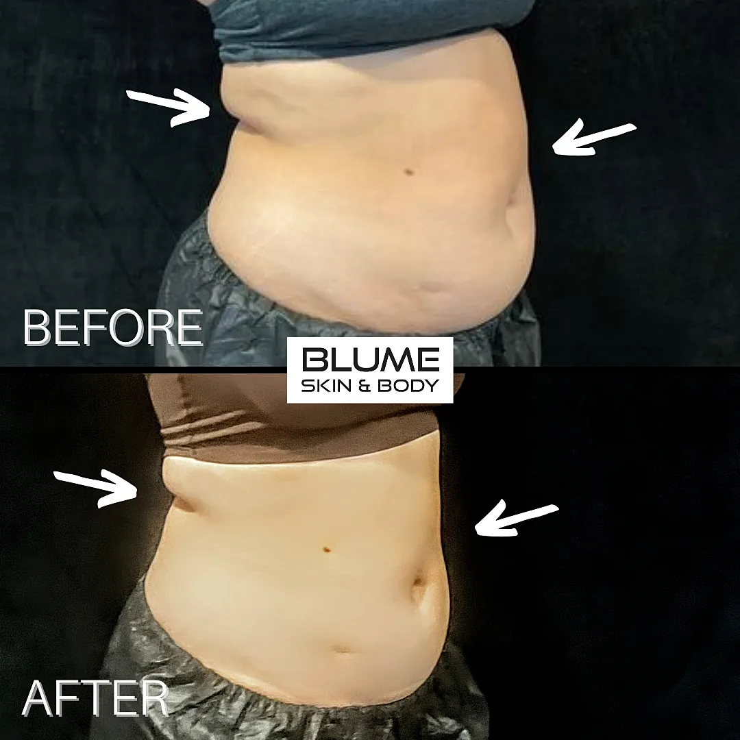 Transformation before and after body treatment.