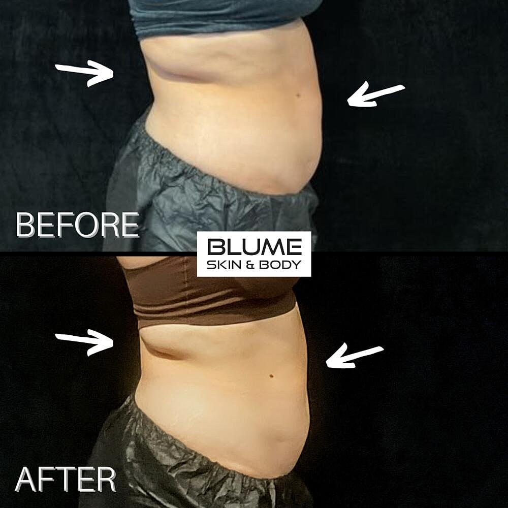 Body Sculpting Before & After
