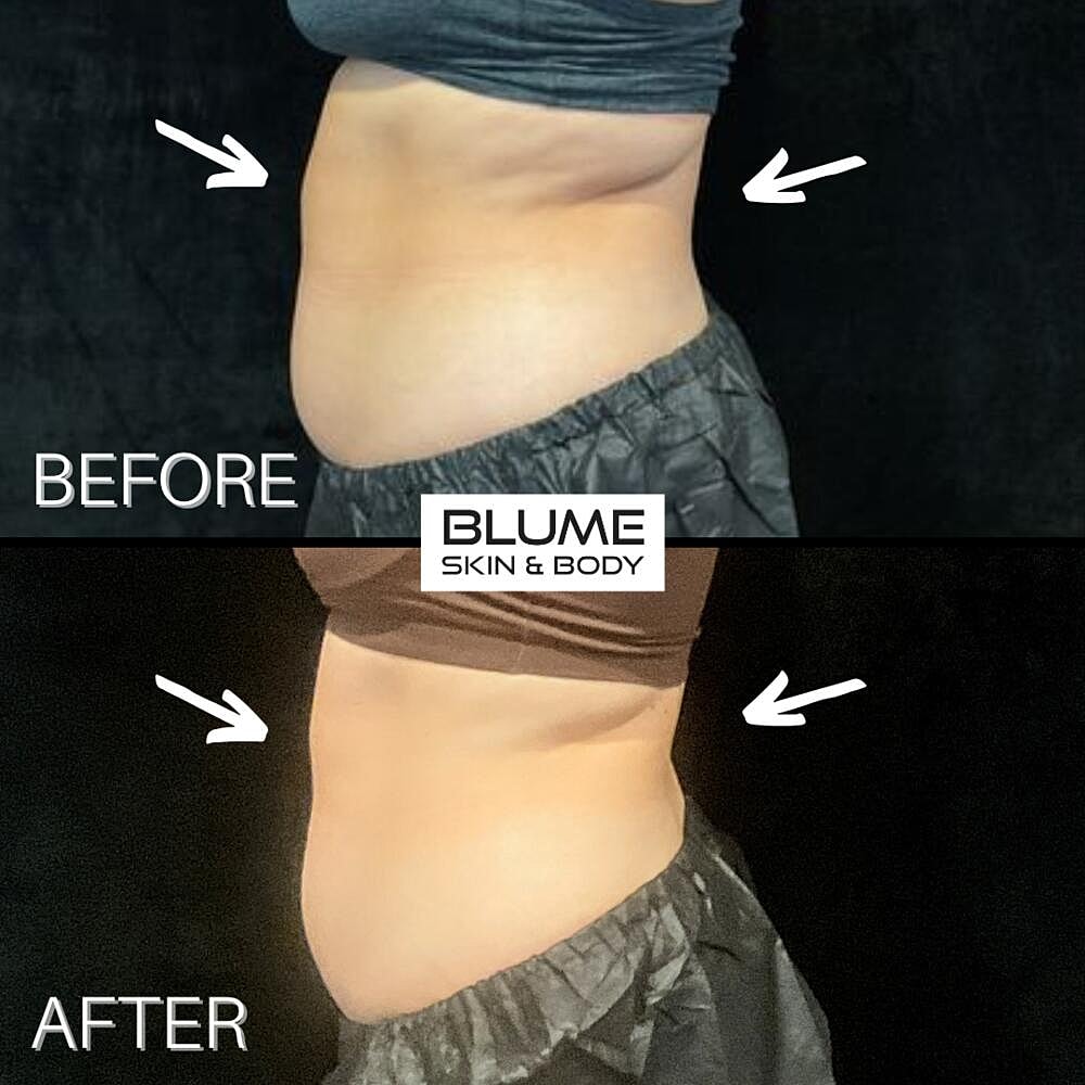 Body Sculpting Before & After