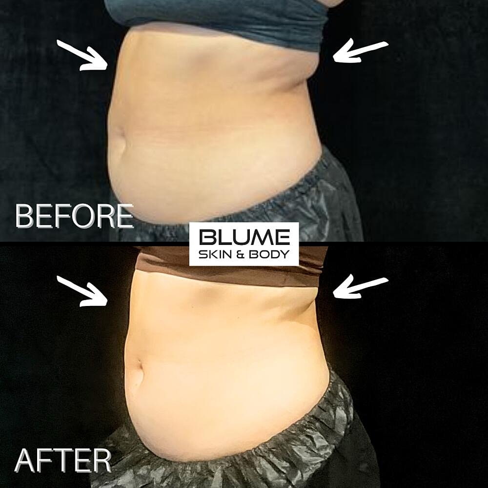 Body Sculpting Before & After