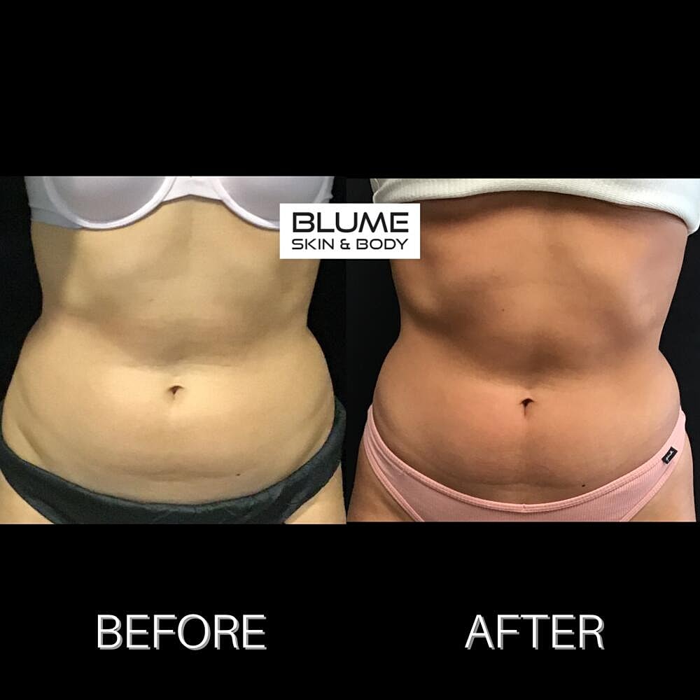 Body Sculpting Before & After