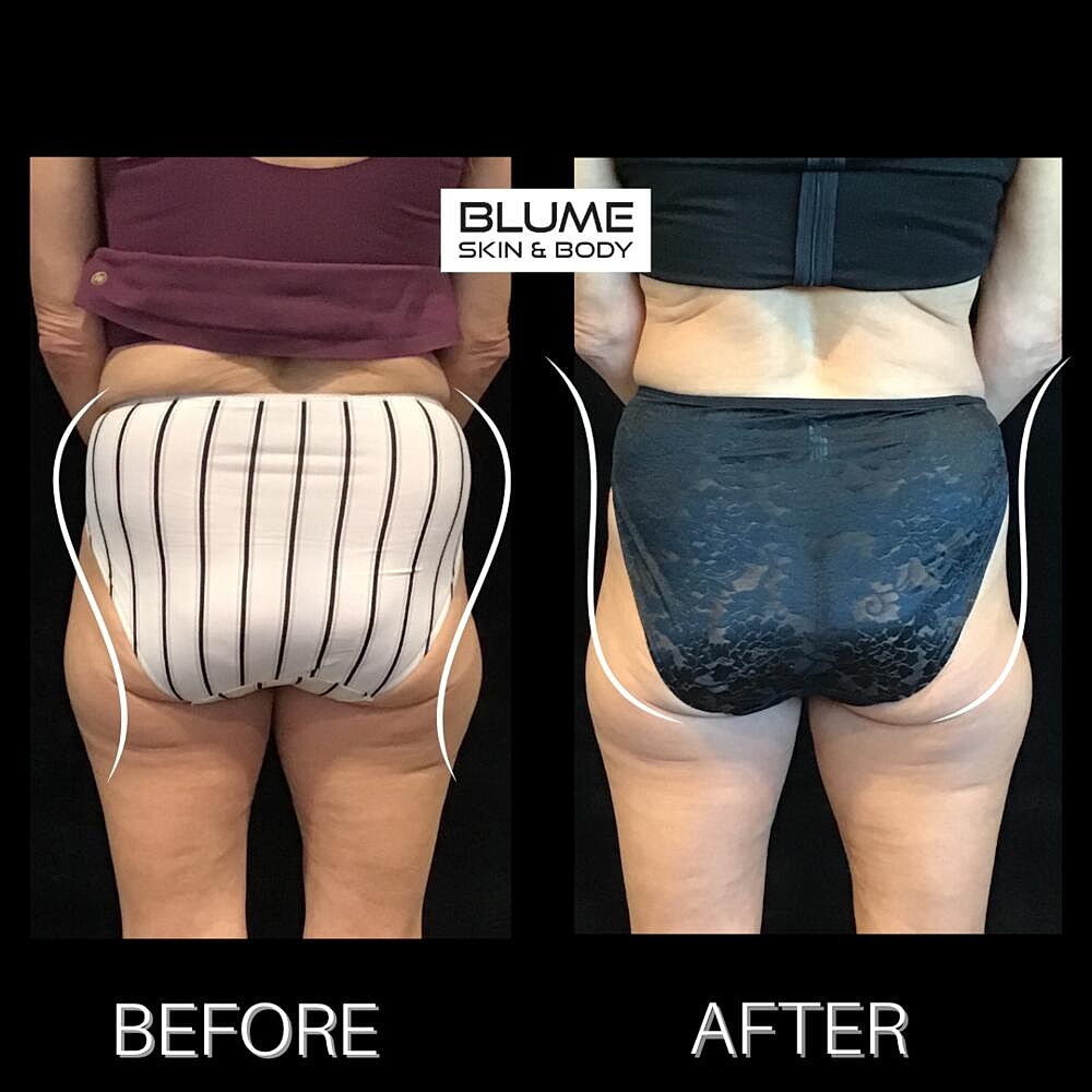 Body Sculpting Before & After