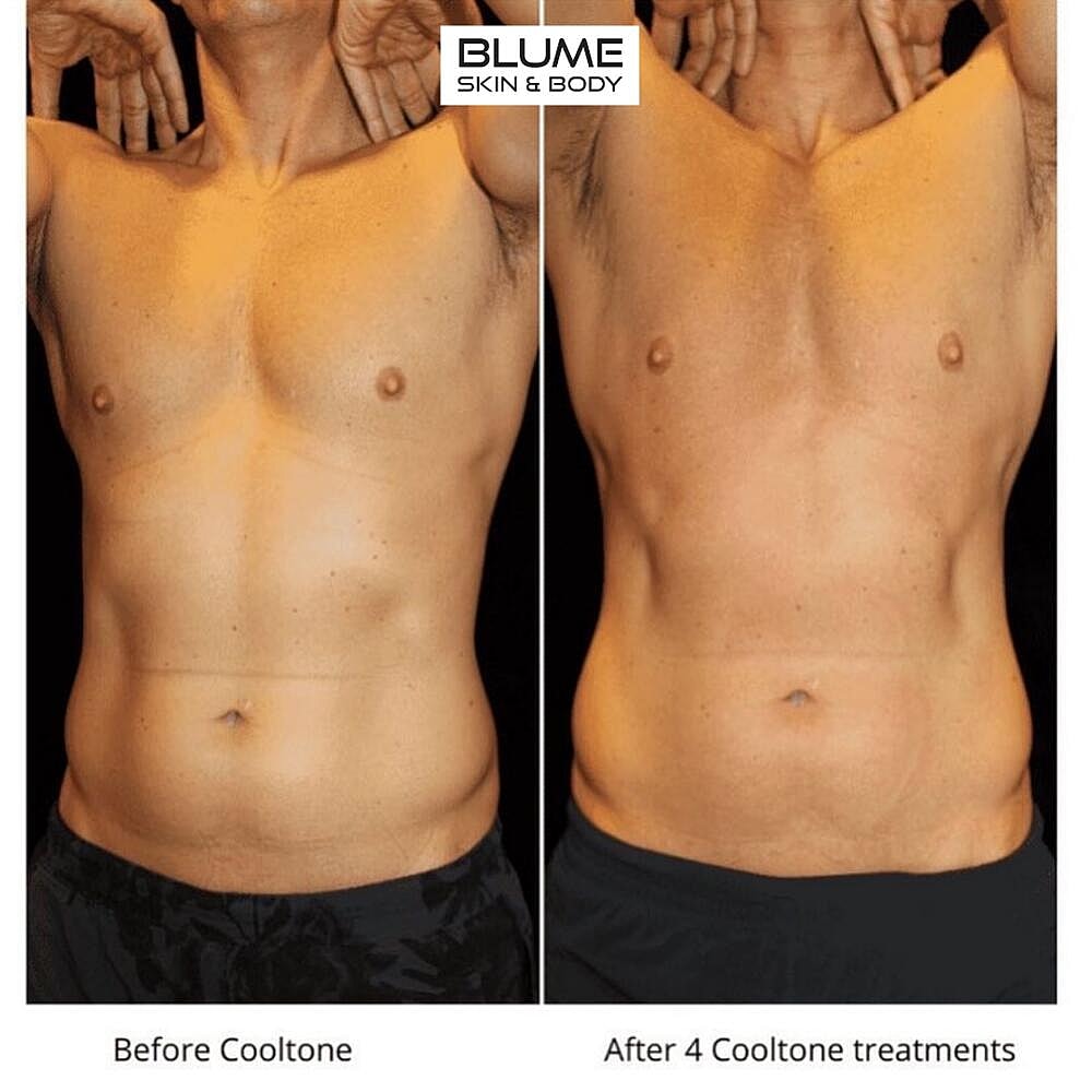 Body Sculpting Before & After