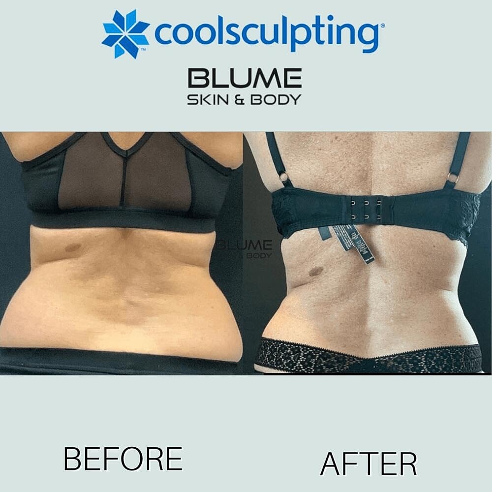Body Sculpting Before & After