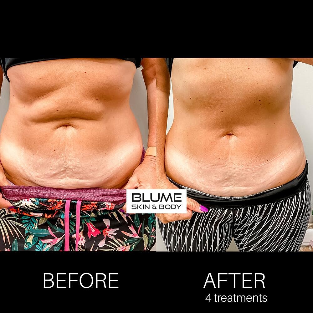 Body Sculpting Before & After