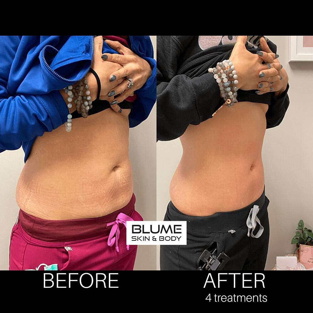 Body Sculpting Before & After