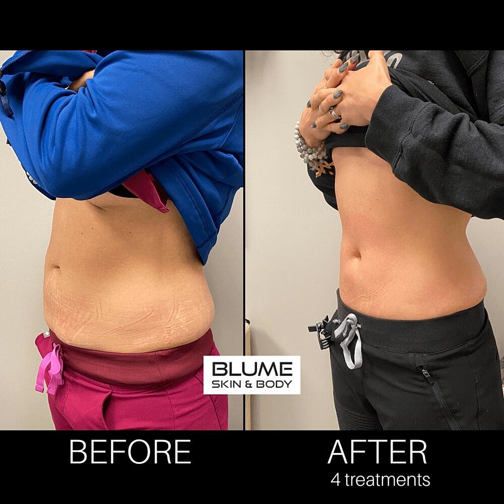 Body Sculpting Before & After