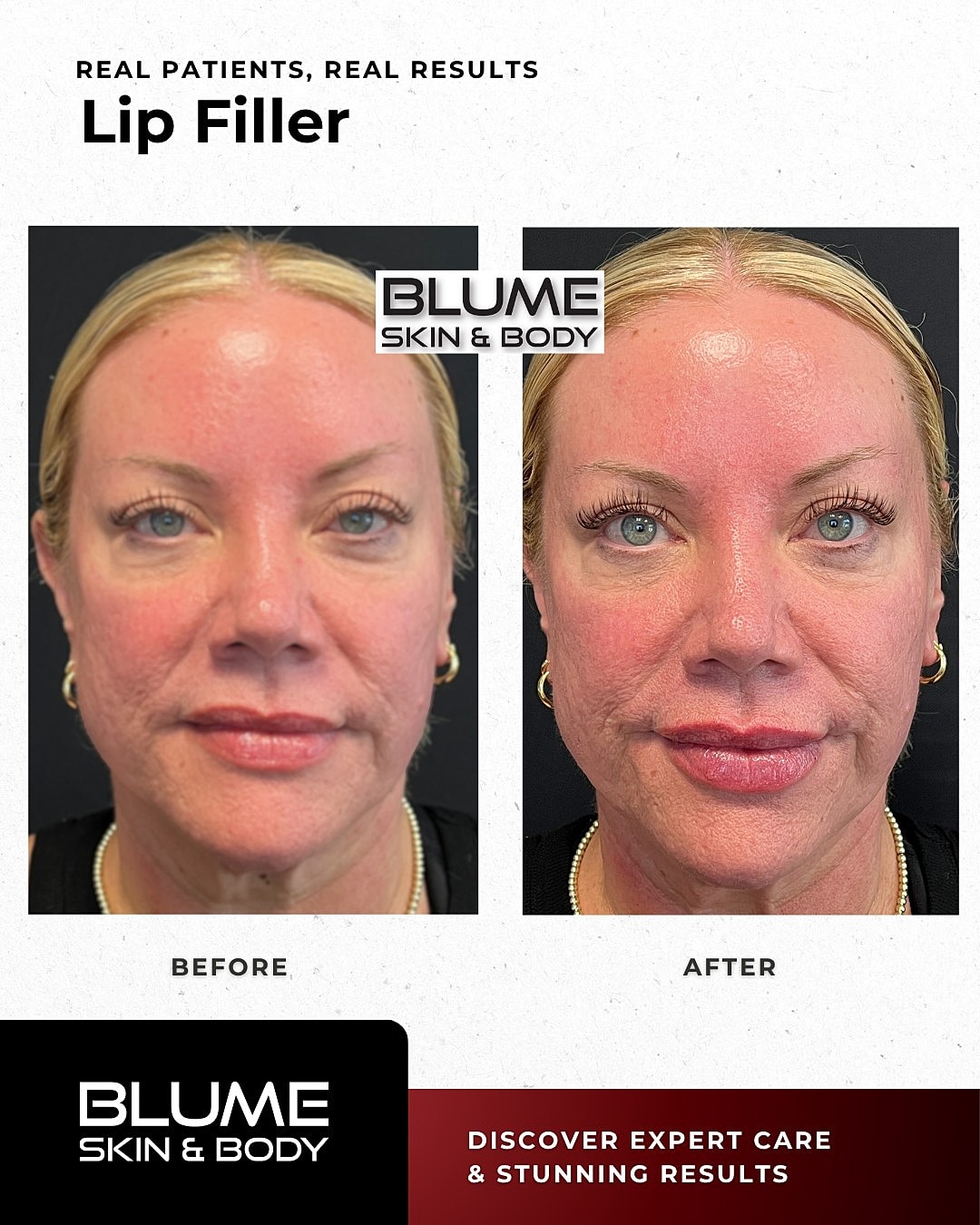Lip Fillers Before & After