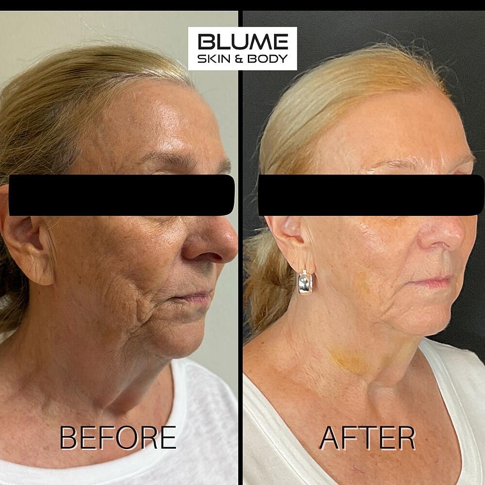 Laser Skin Treatments Before & After