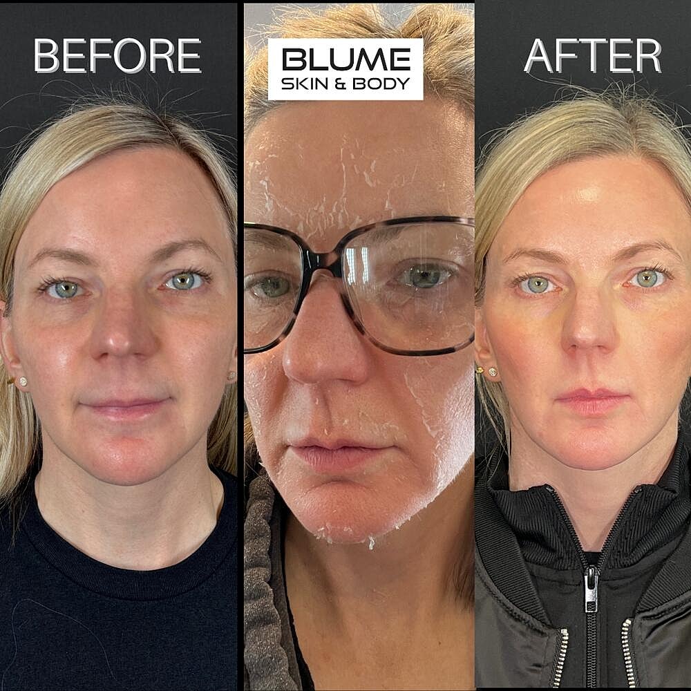 Laser Skin Treatments Before & After