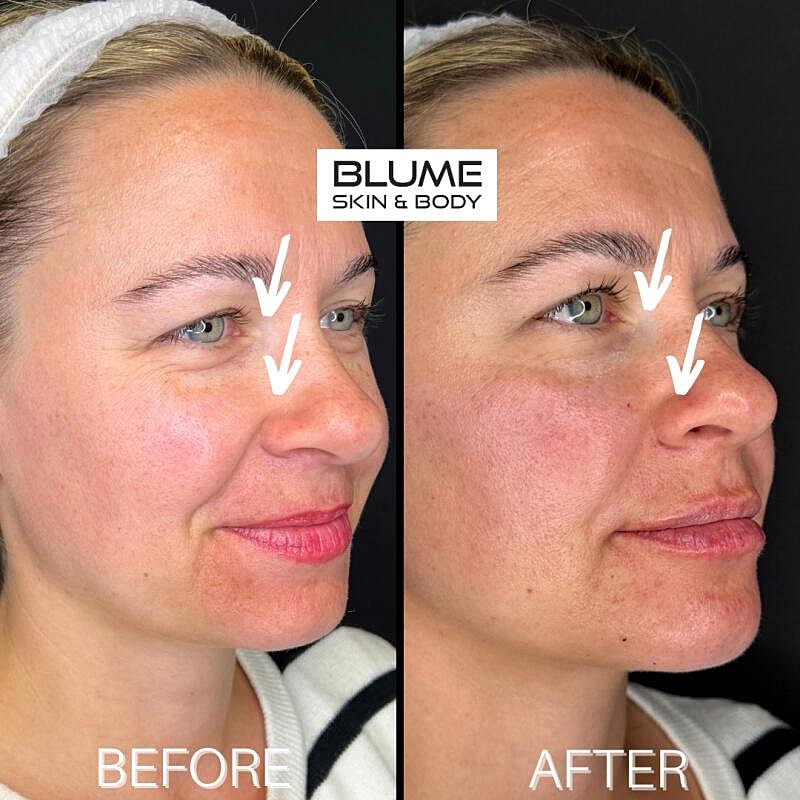 Laser Skin Treatments Before & After