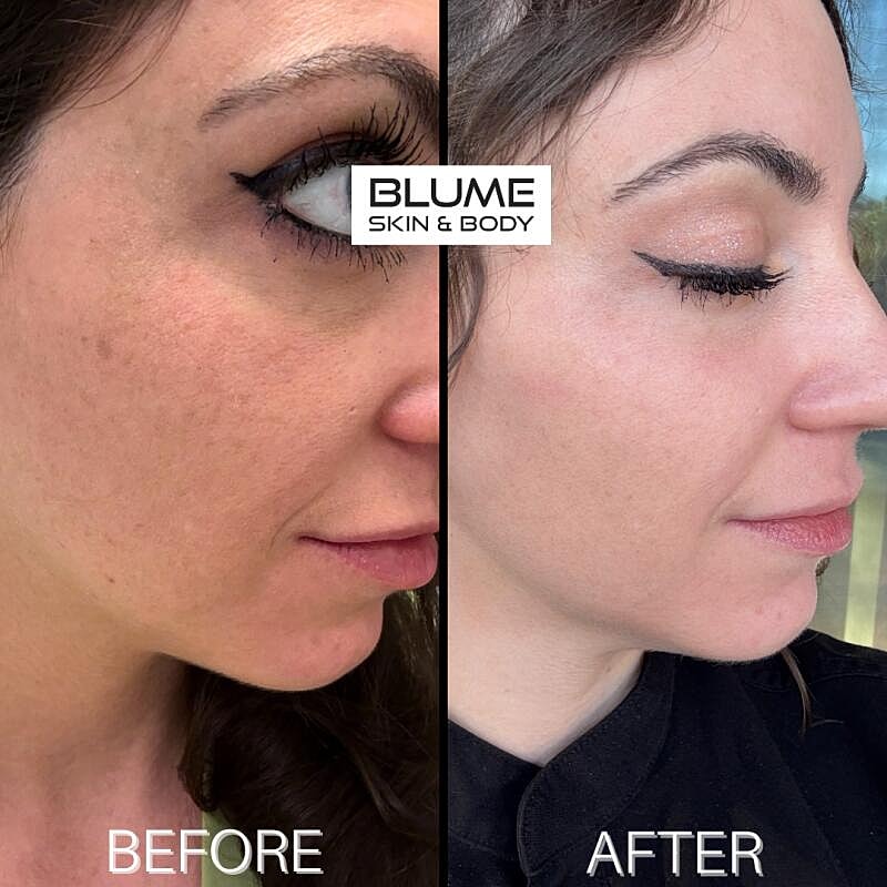 Laser Skin Treatments Before & After