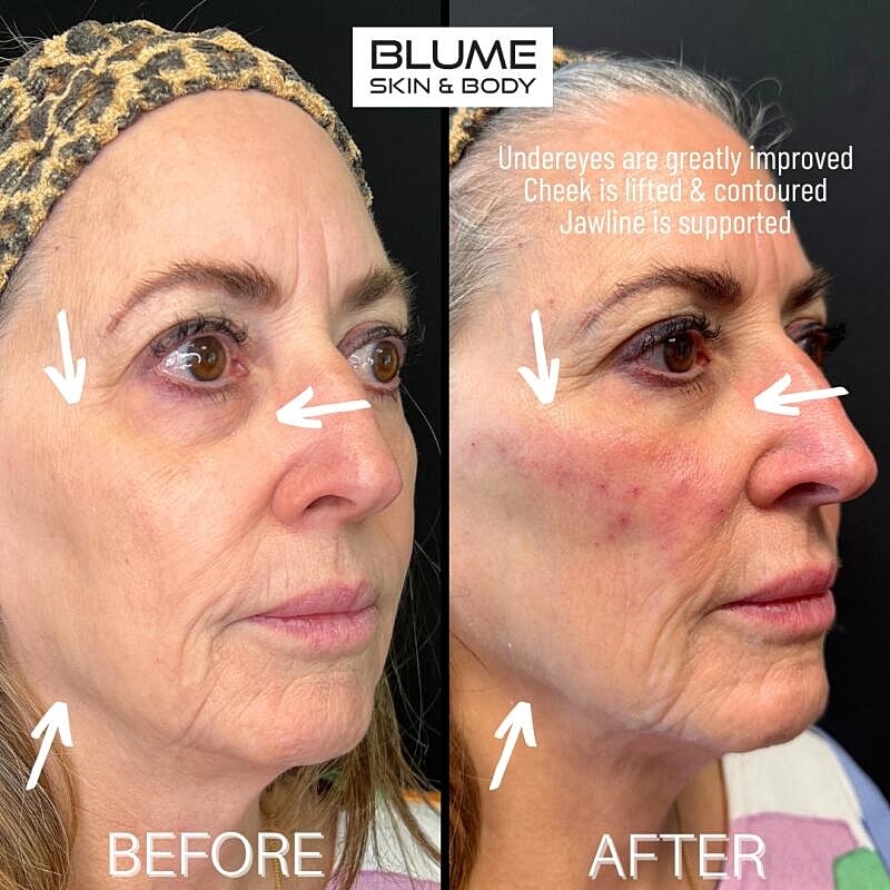 Laser Skin Treatments Before & After