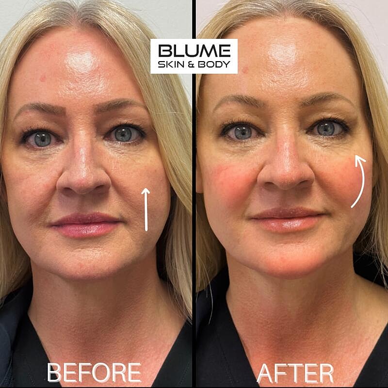 Laser Skin Treatments Before & After