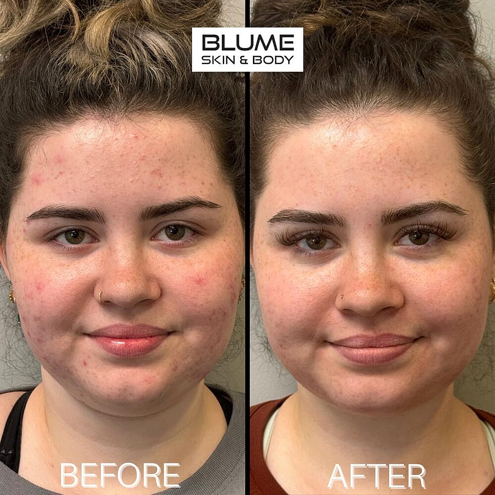 Laser Skin Treatments Before & After