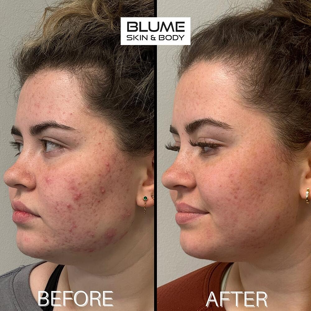 Laser Skin Treatments Before & After