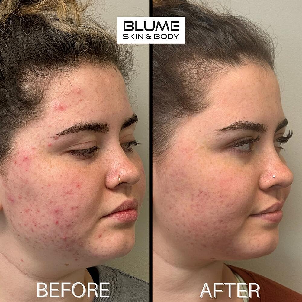 Laser Skin Treatments Before & After