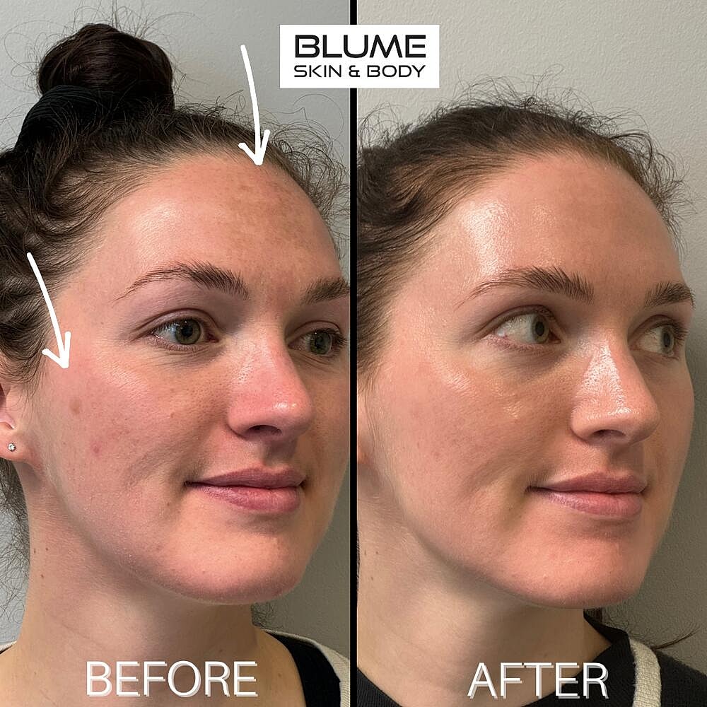 Laser Skin Treatments Before & After