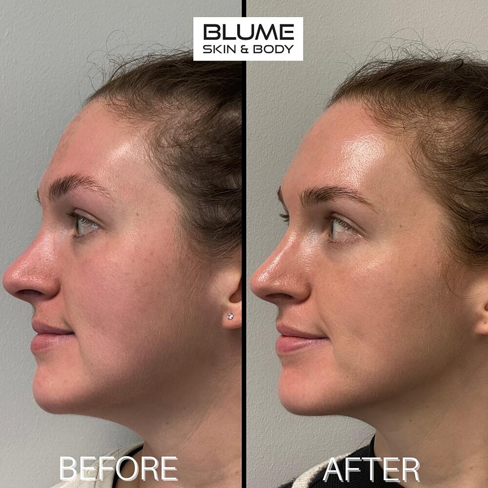 Laser Skin Treatments Before & After