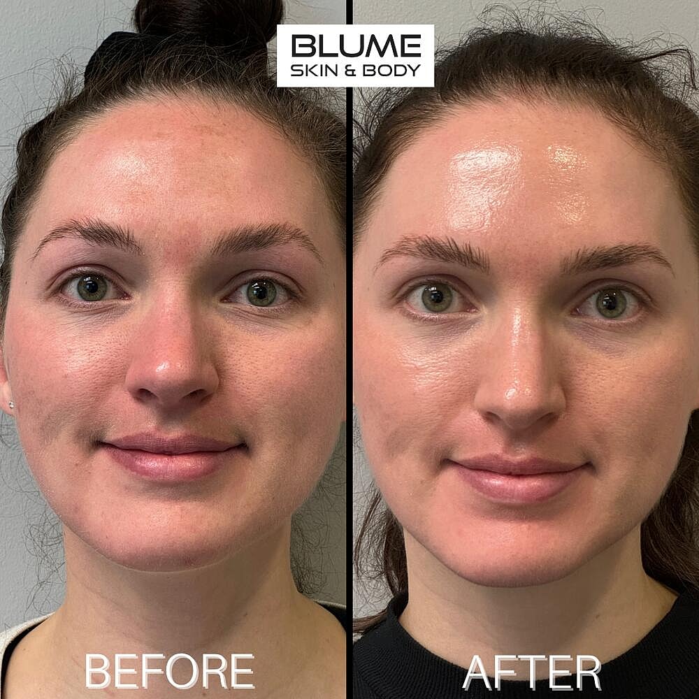 Laser Skin Treatments Before & After