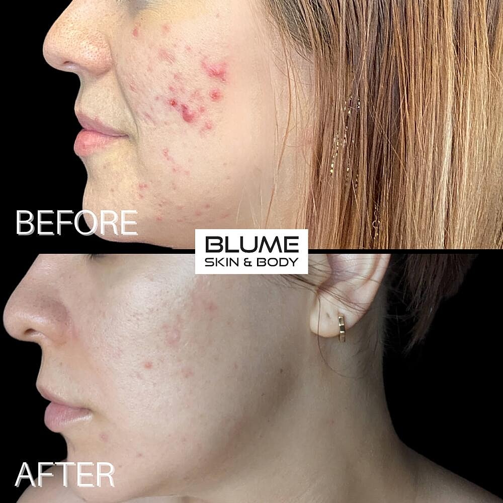 Laser Skin Treatments Before & After