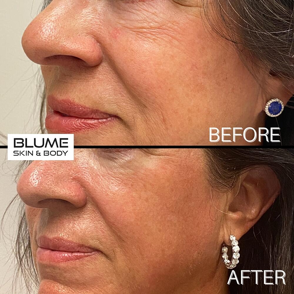 Laser Skin Treatments Before & After