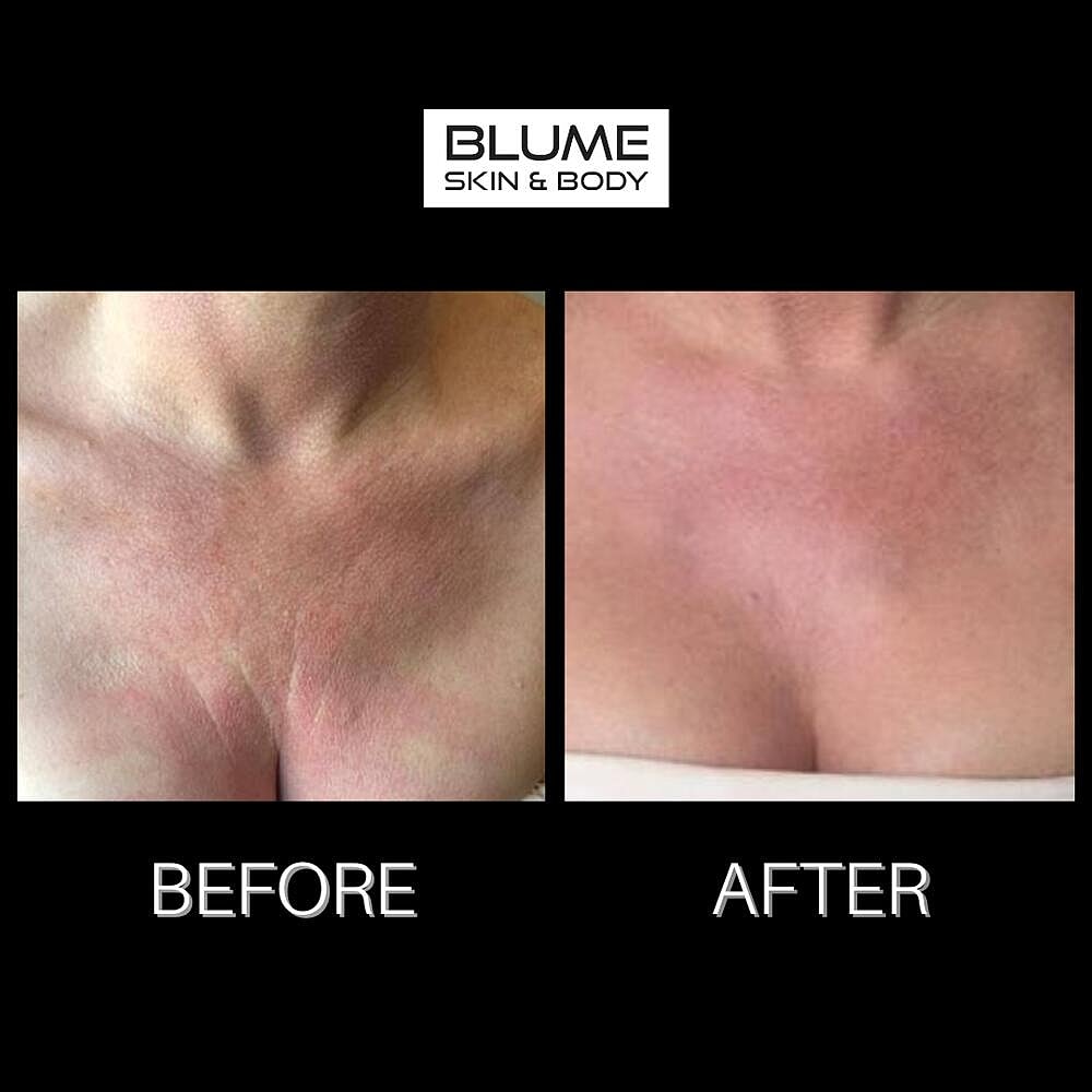 Laser Skin Treatments Before & After