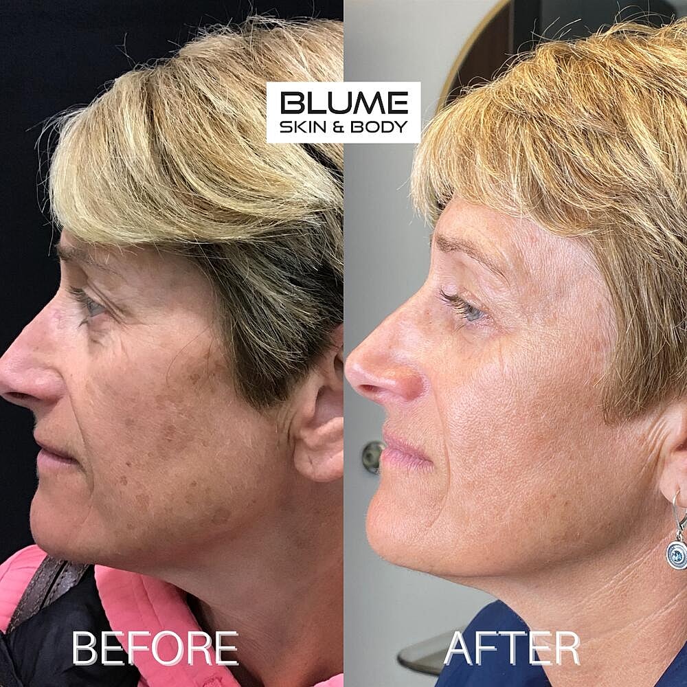 Laser Skin Treatments Before & After