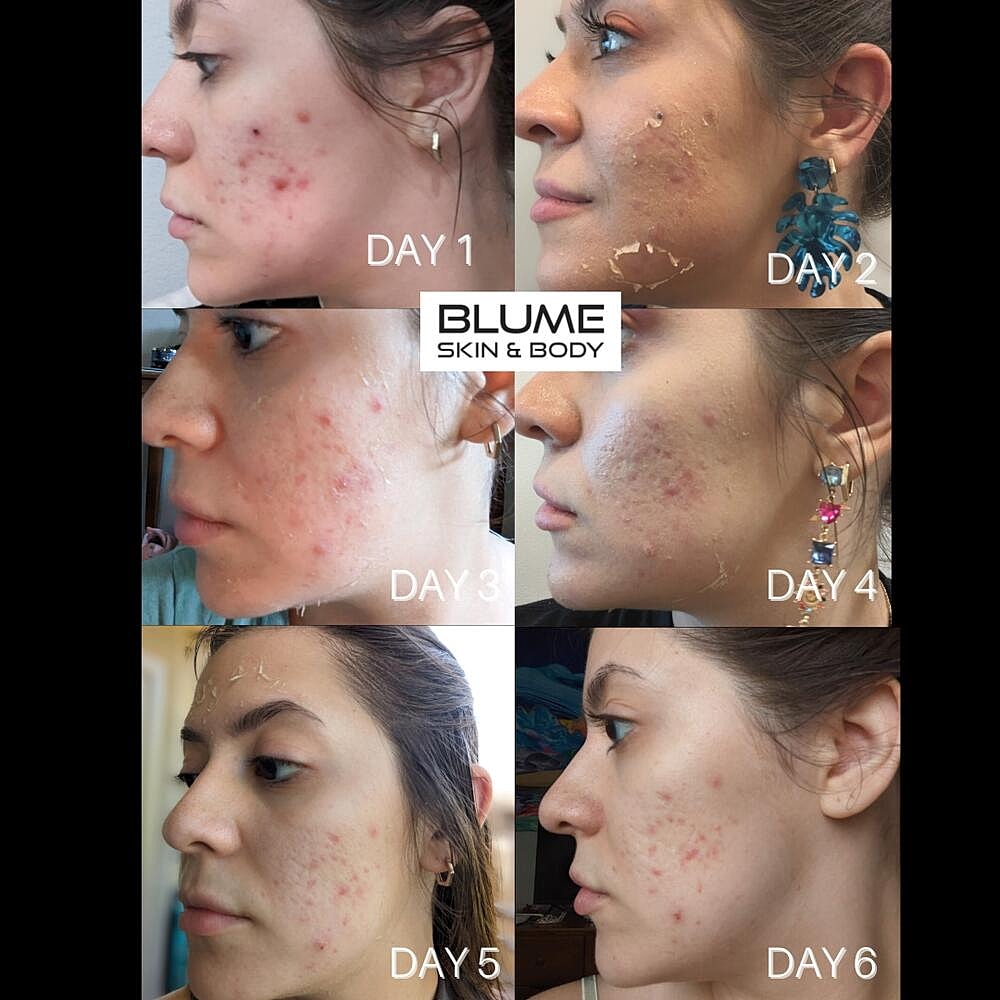 Laser Skin Treatments Before & After