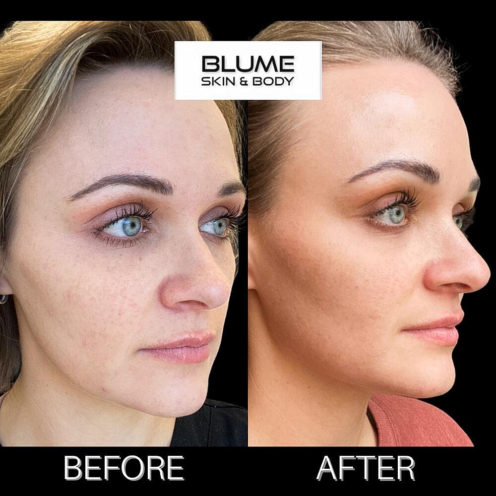 Laser Skin Treatments Before & After