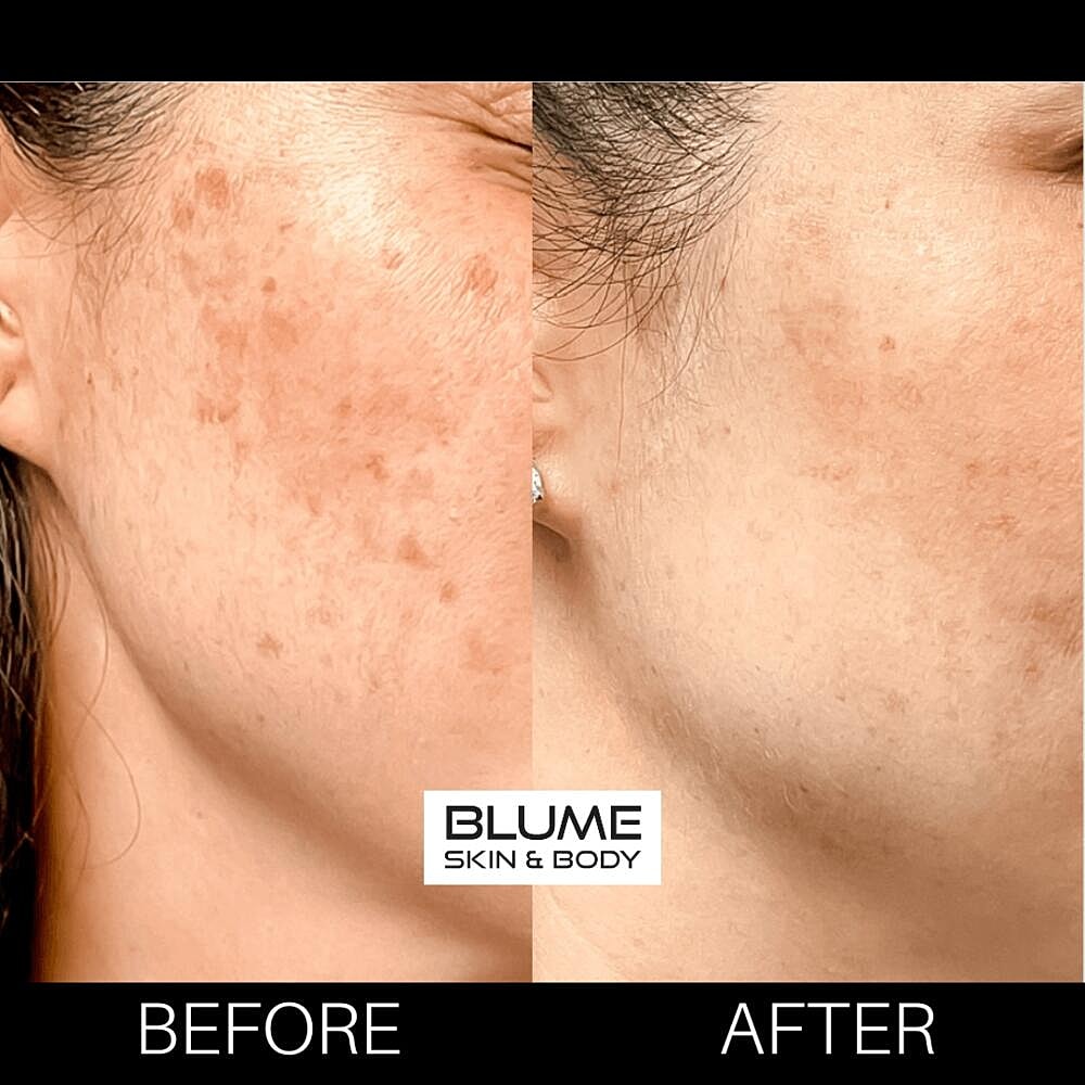Laser Skin Treatments Before & After
