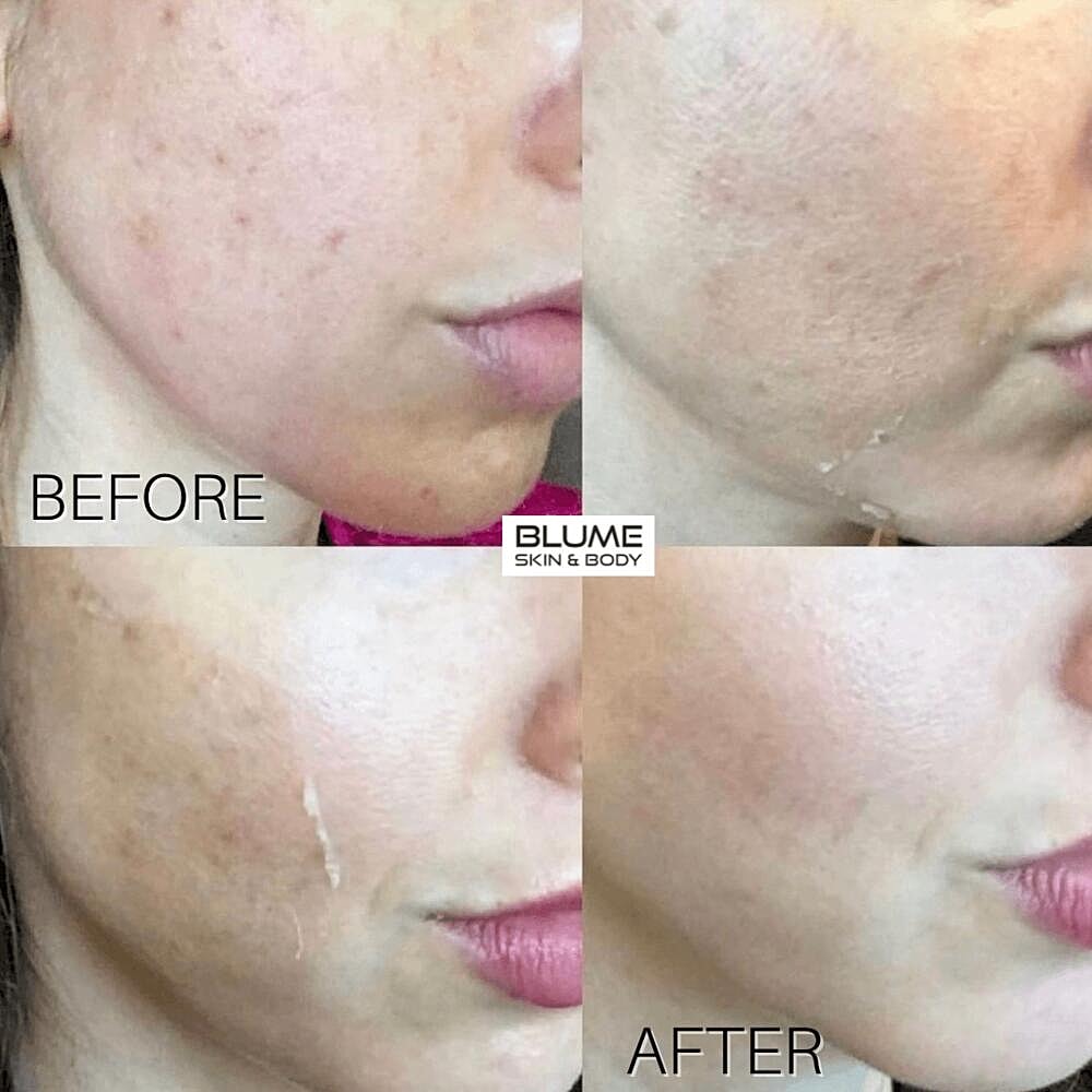Laser Skin Treatments Before & After