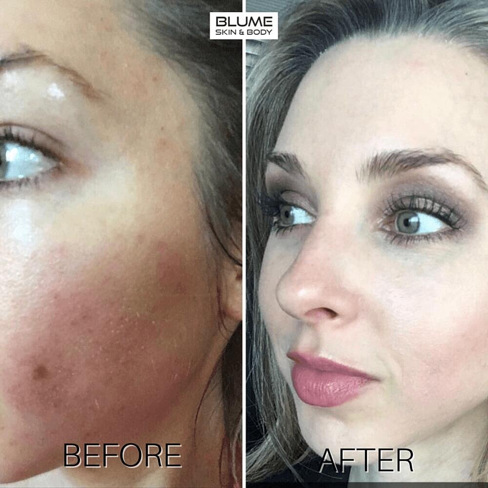 Laser Skin Treatments Before & After